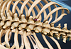 Posterior view of thoracic spine showing kyphoplasty.