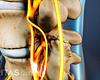 Profile view of lumbar spine with spinal stenosis.
