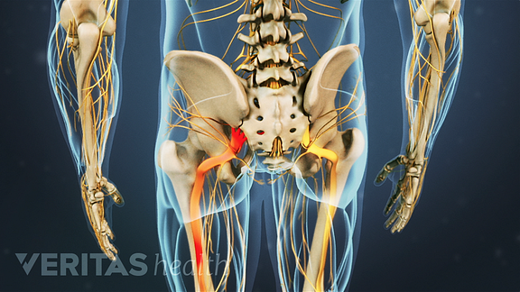 Posterior view of the pelvis showing pain shooting down the sciatic nerve.