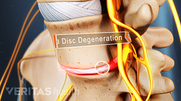 Anterior view of the lumbar spine showing disc degeneration.