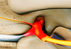 Herniated disc pinching a nerve between two vertebrae.