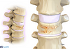 Profile and anterior views of vertebral compression fractures from osteoporosis